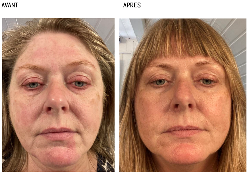 Before After Annemette FR.png